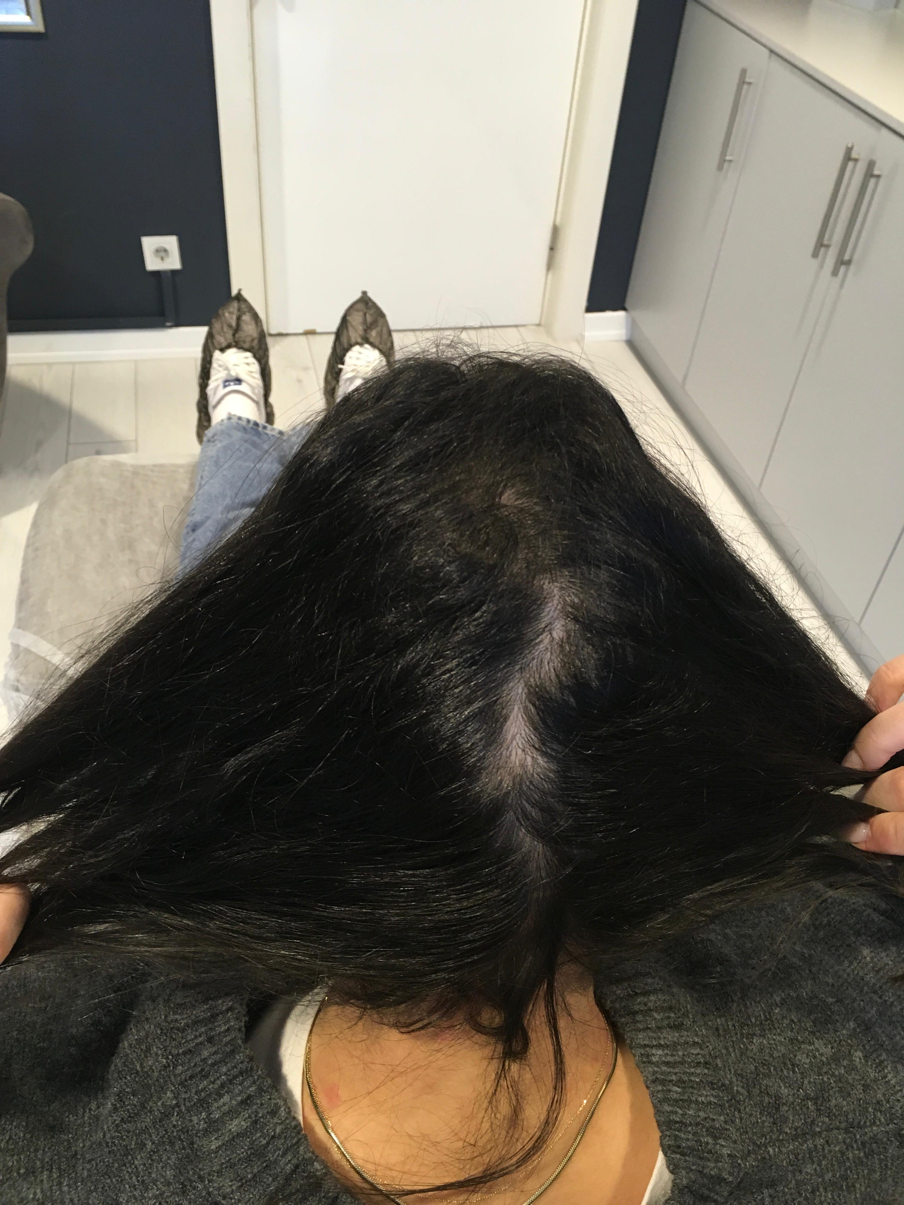 Saç Çoğaltma – 6 Ay - Sonra