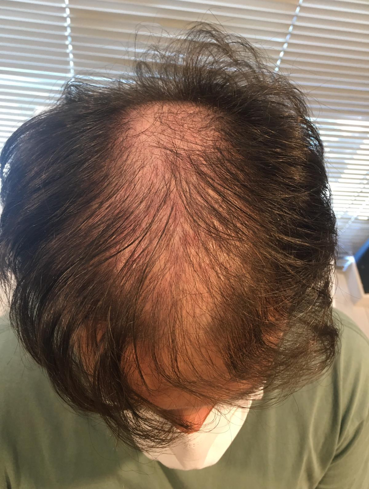 Saç Çoğaltma – 6 Ay - Önce