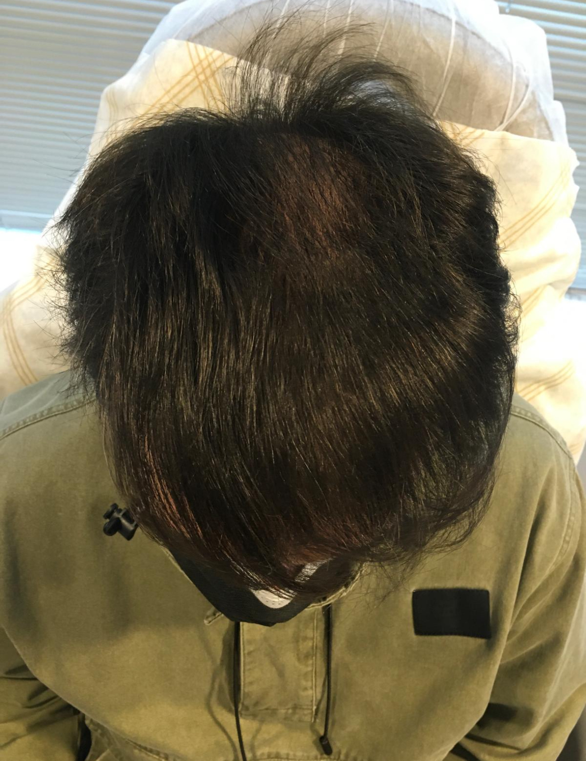 Saç Çoğaltma – 6 Ay - Sonra