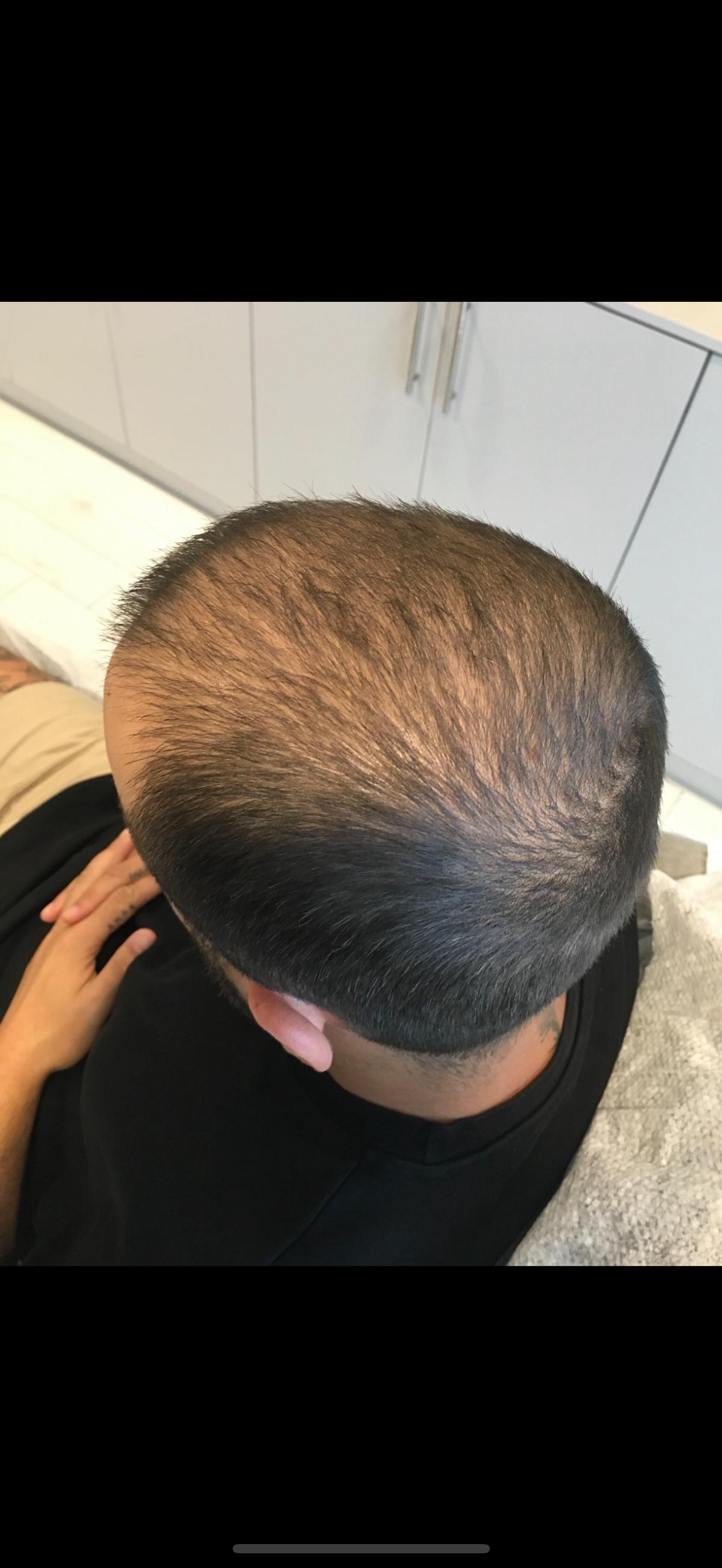 Saç Çoğaltma – 6 Ay - Önce