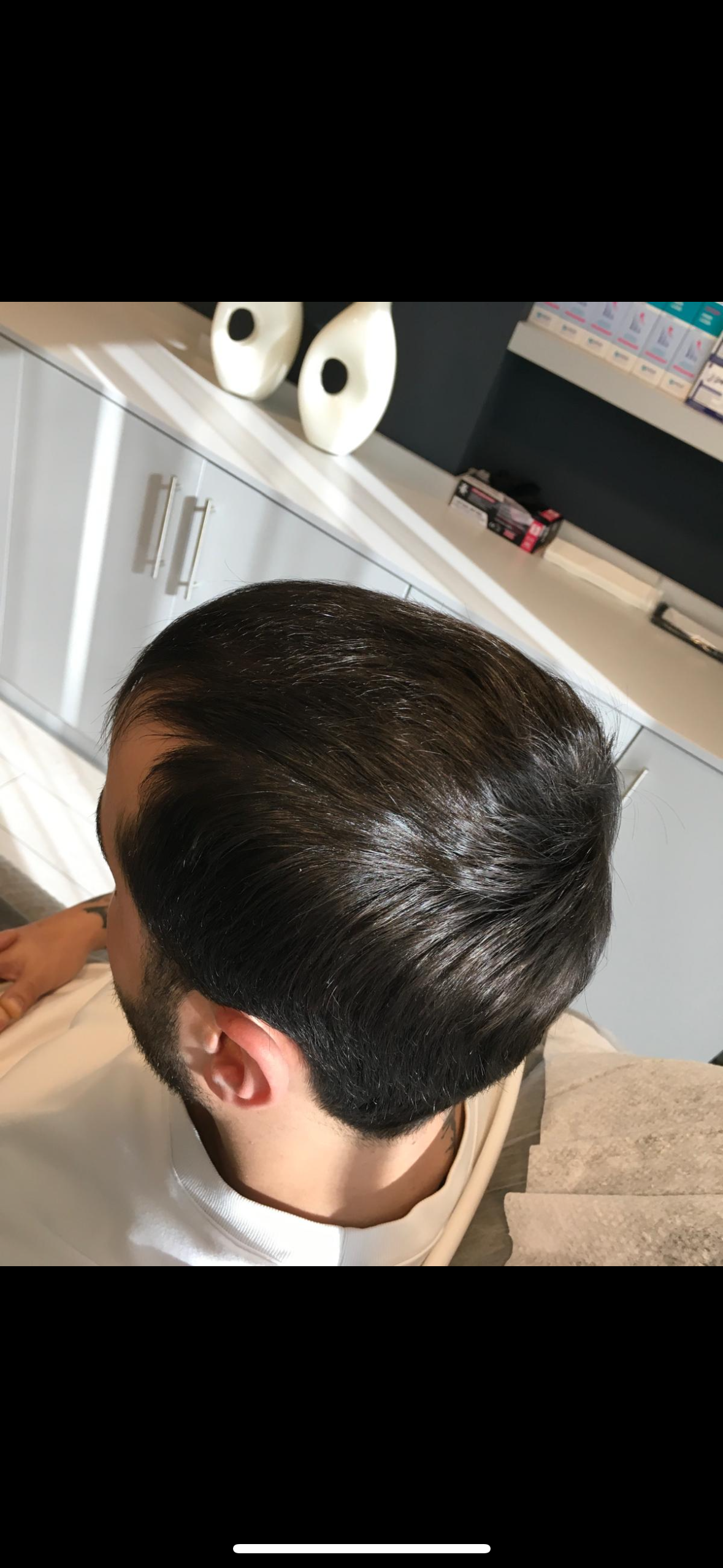 Saç Çoğaltma – 6 Ay - Sonra